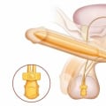 Understanding Penile Implants for Erectile Dysfunction